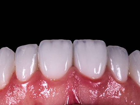 What You Need to Know About Veneers in Dubai