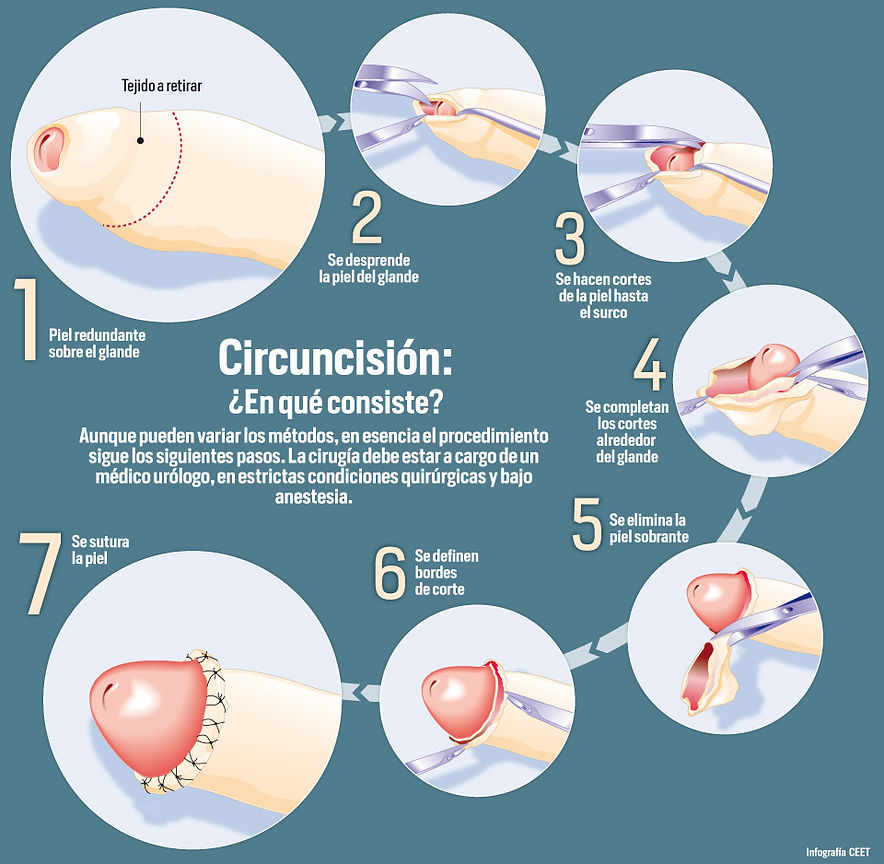 Circuncision tecnica