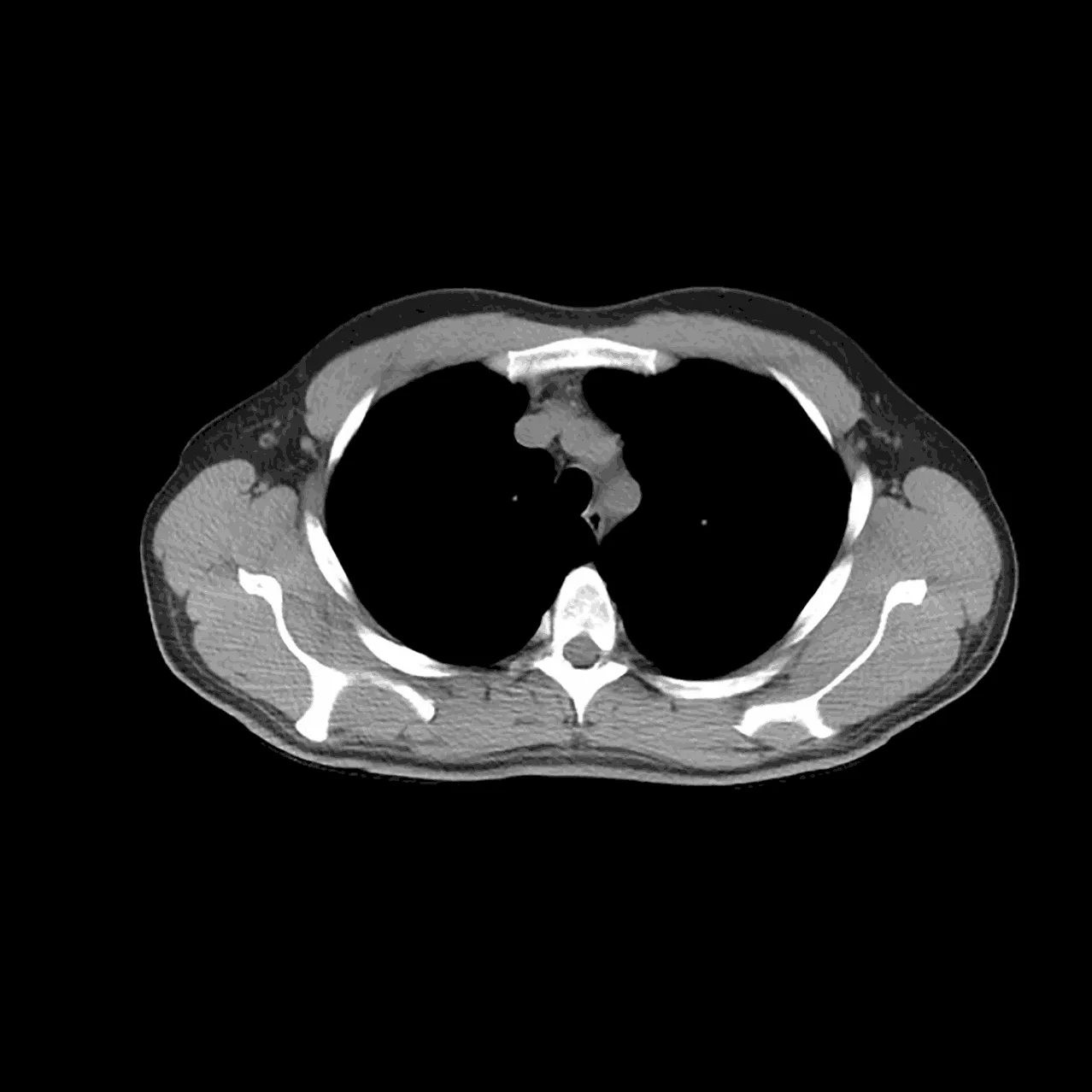 HEALTHSCAN Dx - LungCancerScreening