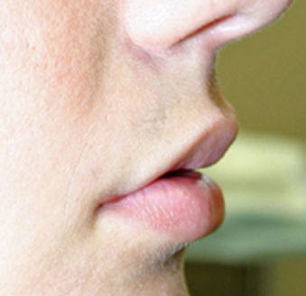 Facial mole after