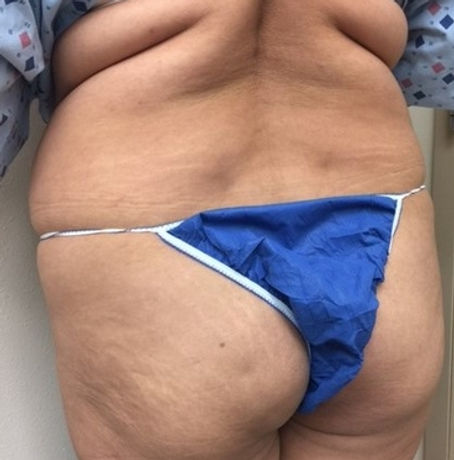 brazilian_buttlift_doctor.jpeg