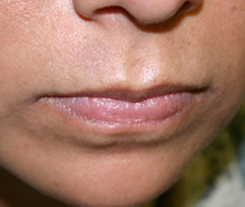 Mole after treatment