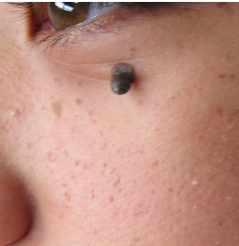 best mole removal doctor before.png