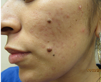 no scar mole removal before.png