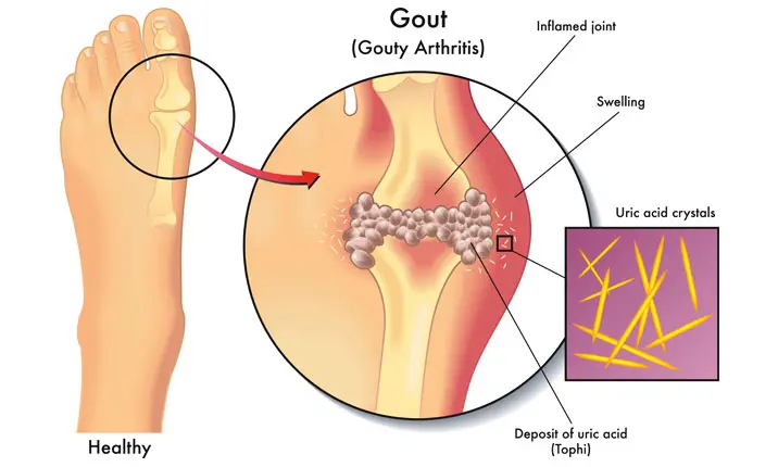 Gout, and a ketogenic diet