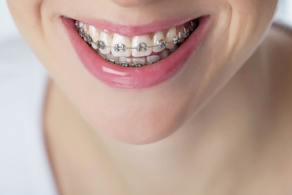 Here s What Having Braces As A 23 Year Old Feels Like