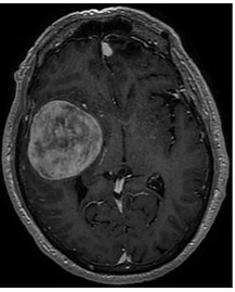 meningioma.jpeg
