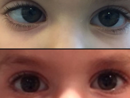 Botox for Eye Alignment: A Gentler Option for Treating Strabismus