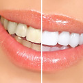clareamento de dente em maringa