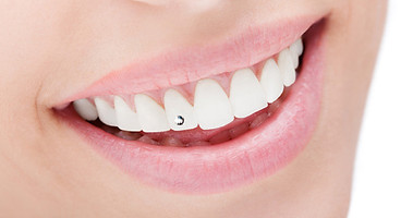 Bleaching – Zahnschmuck