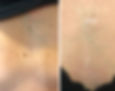 Pigmentation on Décolletage
