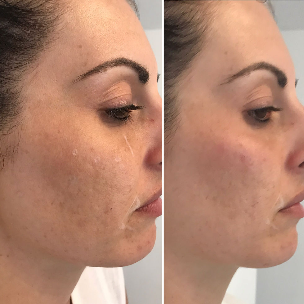 Cheek Filler