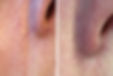 Thread Vein Around The Nose