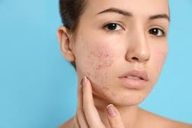 Why Does My acne Keep Showing Up