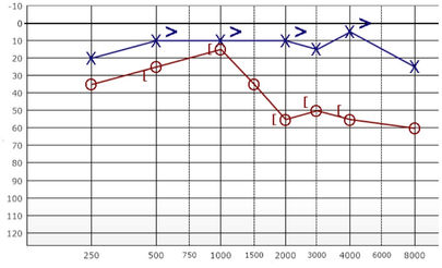 vestibüler schwannoma, akustik nörinom, vestibüler hastalıklar, işitme kaybı, sensörinöral tip işitme kaybı, odyogram örnekleri, konuşma odyometrisi sonuçları...