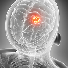 Beyinsapı Tümörleri: Ekstra ve İntra-Aksiyel Lezyonlar ve ABR Değerlendirmeleri