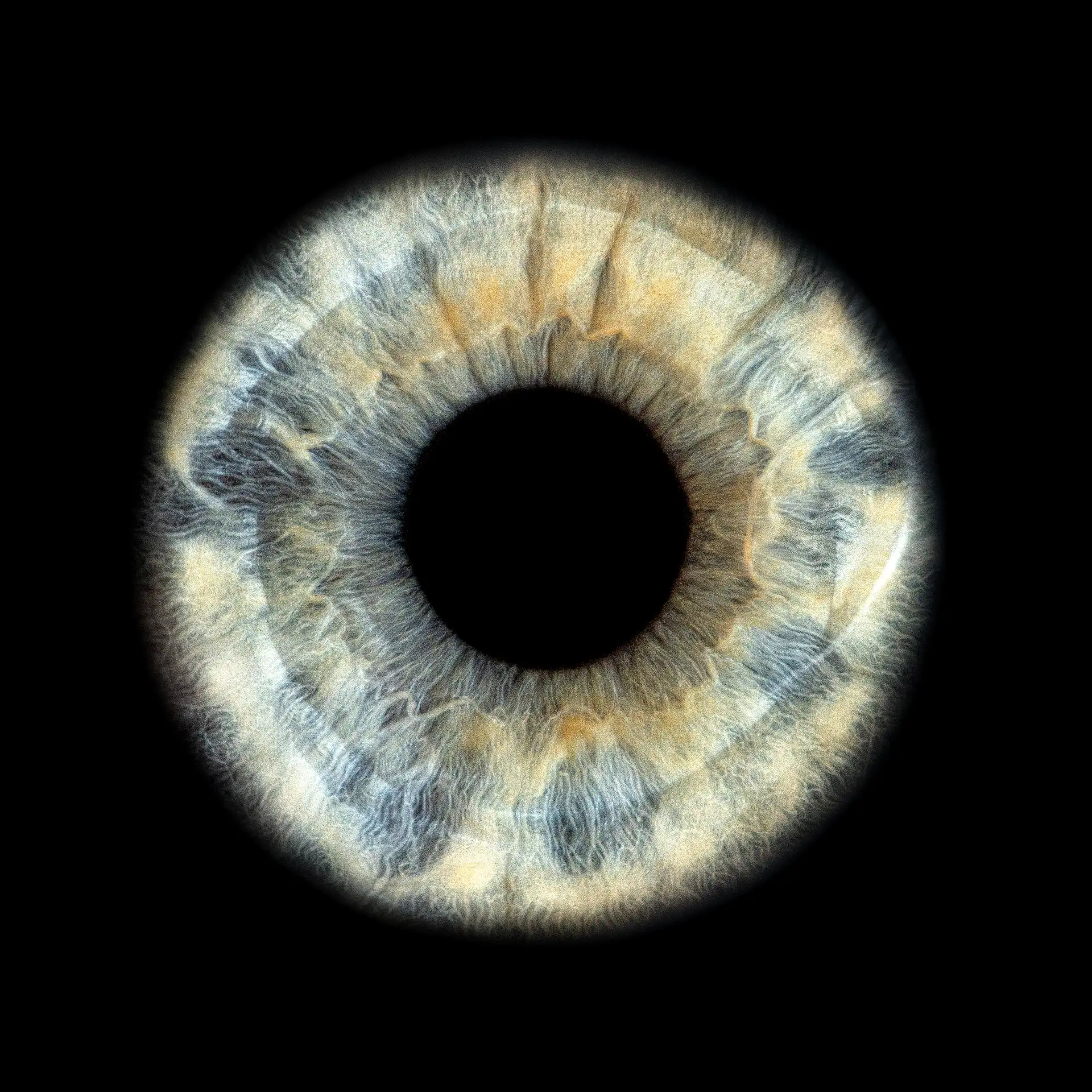 Sohn mit blauer Iris und grossem oberflächigem Braunanteil rund um den Iris Kranz