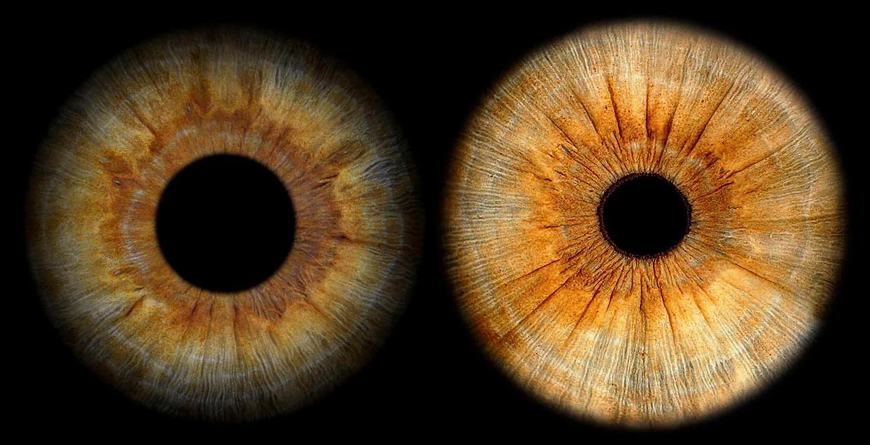 Ein Vergleich, dass Irisfotografie nicht Iris Fotografie bedeutet. Hier haben wir zweimal dasselbe Auge und total unterschiedliche Ergebnisse