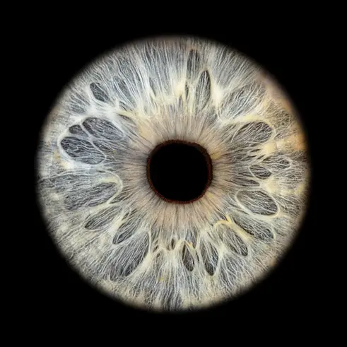 Extrovertierte Iris mit tropfenförmigen Krypten