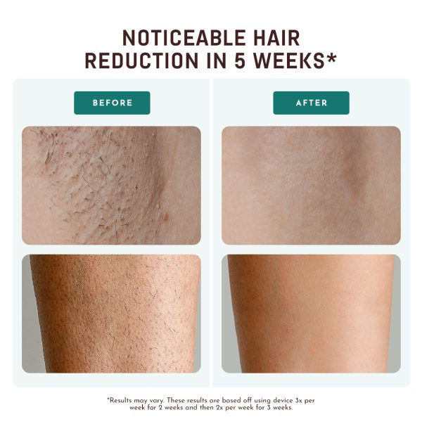 Thumbnail: GlacierPro Laser Hair Removal