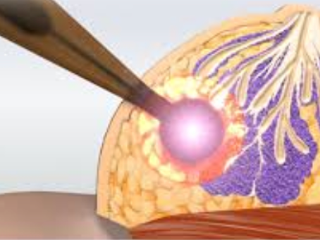 Intraoperative Radiation for Breast Cancer