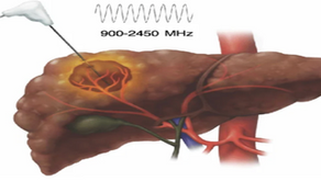 Microwave Ablation (MWA) for Solid Tumors