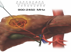 Microwave Ablation (MWA) for Solid Tumors