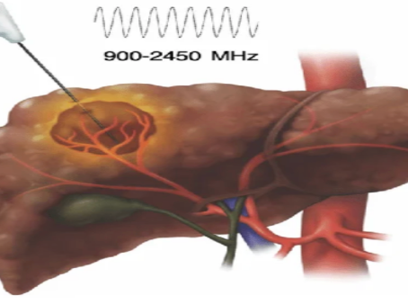 Microwave Ablation (MWA) for Solid Tumors