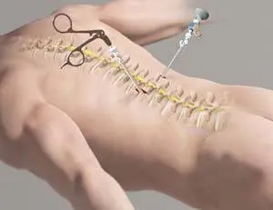 Keyhole Spine Surgery