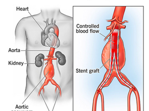 Fixing Aneurysms Without Open Surgery: What Is Endovascular Repair