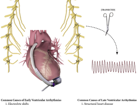 Cardiac Sympathetic Denervation