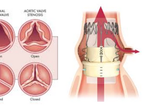Sutureless Aortic Valve Replacement