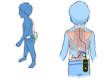Neuromodulation