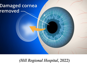 Corneal Transplantation Using Lab-Grown Corneas