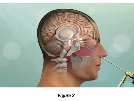 Cerebrospinal Fluid (CSF) Leak Management After Skull Base Surgery