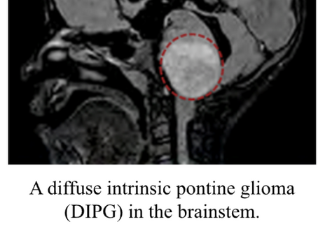 Brainstem Glioma Treatment