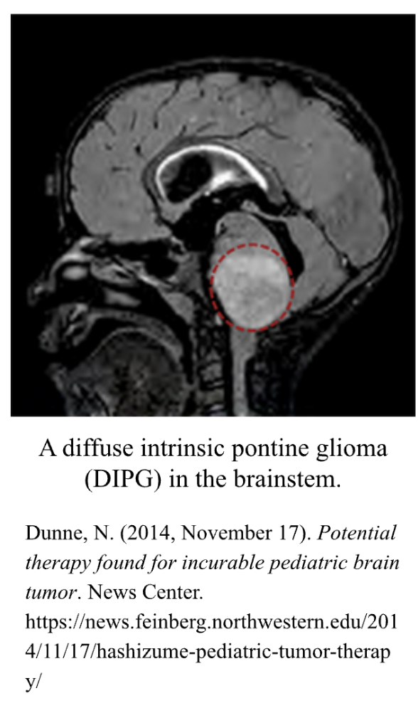 Brainstem Glioma Treatment