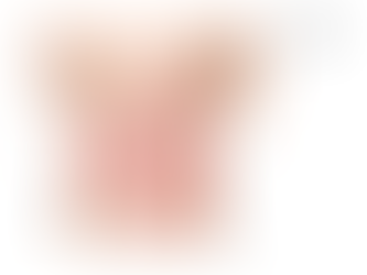 Laparoscopic Appendectomy