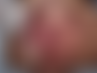 Using Lasers to treat Twin-to-Twin TransfusionSyndrome