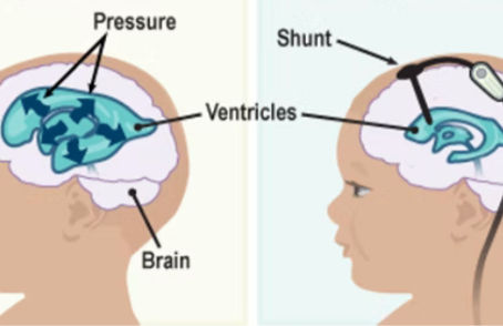 Dr. Alexa Canady: Healer of Hydrocephalus
