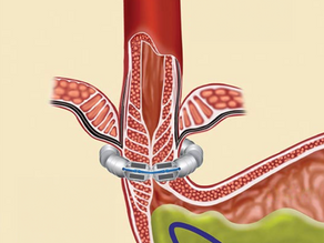 Linx Reflux Management System