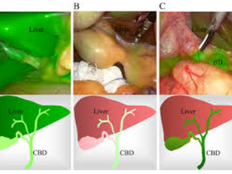 Fluorescent Dye Use for Bile Duct Identification in Gallbladder Surgery