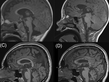 Corpus Callosotomy: Disconnecting the Brain to Stop the Storm