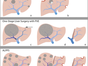 Parenchyma-Sparing Liver Resection