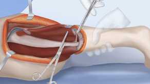 Rotationplasty: A Functional Approach to Limb Reconstruction and Mobility