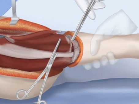 Rotationplasty: A Functional Approach to Limb Reconstruction and Mobility