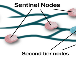 Sentinel Lymph Node Biopsy in Cancer Surgery