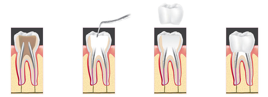 root-canal-therapy