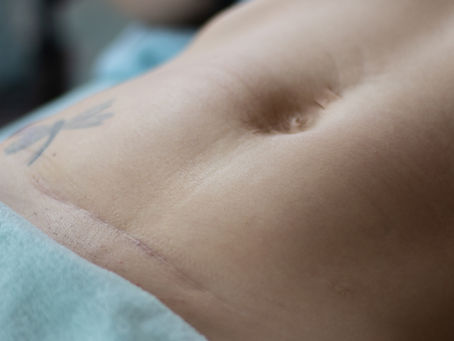 HERMotherhood: The Hidden Reality of C-Section Recovery — What Every Woman Deserves to Know