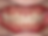 INNOSMILE | Perfect Clear Aligner